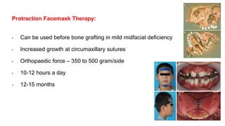 Protraction Facemask Therapy:
• Can be used before bone grafting in mild midfacial deficiency
• Increased growth at circumaxillary sutures
• Orthopaedic force – 350 to 500 gram/side
• 10-12 hours a day
• 12-15 months
116
 