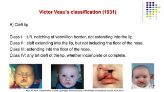 Victor Veau’s classification (1931)
A] Cleft lip
Class I : U/L notching of vermillion border, not extending into the lip.
Class II : cleft extending into the lip, but not including the floor of the nose.
Class III: extending into the floor of the nose.
Class IV: any b/l cleft of the lip, whether incomplete or complete.
34
Allori AC et al. Classification of Cleft Lip/Palate: Then and Now. Cleft Palate–Craniofacial Journal 2016;53(1)
 