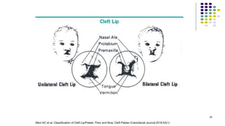 35
Allori AC et al. Classification of Cleft Lip/Palate: Then and Now. Cleft Palate–Craniofacial Journal 2016;53(1)
 