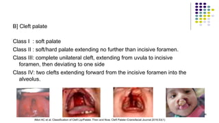 B] Cleft palate
Class I : soft palate
Class II : soft/hard palate extending no further than incisive foramen.
Class III: complete unilateral cleft, extending from uvula to incisive
foramen, then deviating to one side
Class IV: two clefts extending forward from the incisive foramen into the
alveolus.
36
Allori AC et al. Classification of Cleft Lip/Palate: Then and Now. Cleft Palate–Craniofacial Journal 2016;53(1)
 