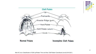 37
Allori AC et al. Classification of Cleft Lip/Palate: Then and Now. Cleft Palate–Craniofacial Journal 2016;53(1)
 
