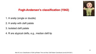 Fogh-Andersen’s classification (1942)
1. H arelip (single or double)
2. H arelip with cleft palate
3. Isolated cleft palate
4. R are atypical clefts, e.g., median cleft lip
38
Allori AC et al. Classification of Cleft Lip/Palate: Then and Now. Cleft Palate–Craniofacial Journal 2016;53(1)
 