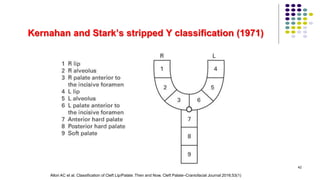 Kernahan and Stark’s stripped Y classification (1971)
42
Allori AC et al. Classification of Cleft Lip/Palate: Then and Now. Cleft Palate–Craniofacial Journal 2016;53(1)
 
