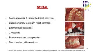 DENTAL
 Tooth agenesis, hypodontia (most common)
 Supernumerary teeth (2nd most common)
 Enamel hypoplasia (CI)
 Crossbites
 Ectopic eruption, transposition
 Taurodontism, dilacerations
56
*Jamal GA et al. Prevalence of Dental Anomalies in a Population of Cleft Lip and Palate Patients. Cleft Palate–Craniofacial Journal, 2010;47(4):413-20
 