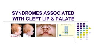 SYNDROMES ASSOCIATED
WITH CLEFT LIP & PALATE
 