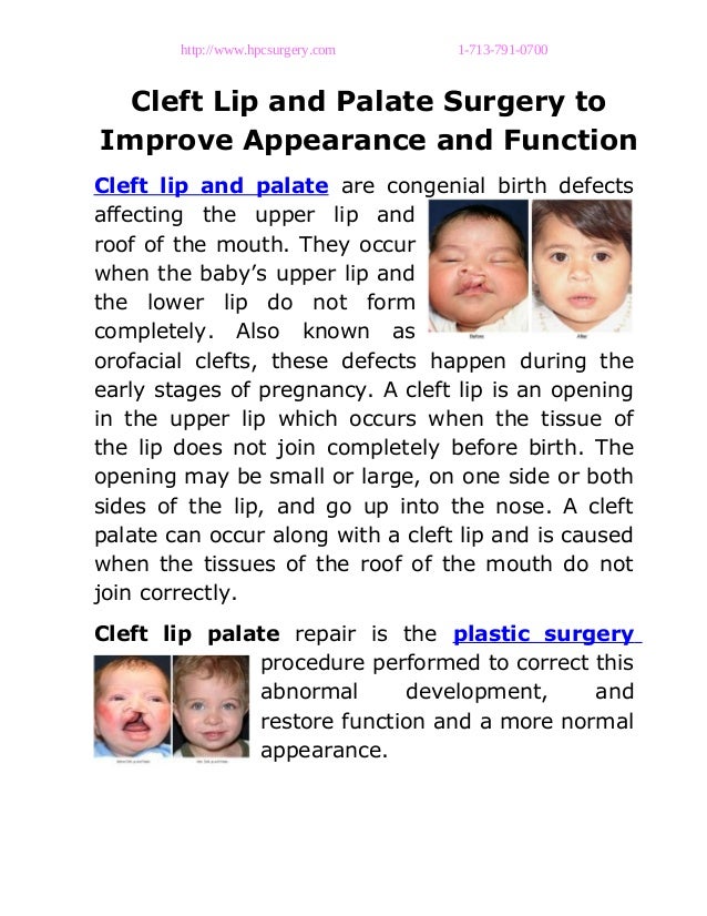Cleft lip and palate surgery to improve appearance and function