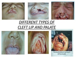 DIFFERENT TYPES OF
CLEFT LIP AND PALATE
 