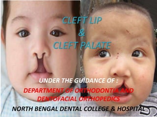 CLEFT LIP
&
CLEFT PALATE
UNDER THE GUIDANCE OF :
DEPARTMENT OF ORTHODONTIA AND
DENTOFACIAL ORTHOPEDICS
NORTH BENGAL DENTAL COLLEGE & HOSPITAL
 