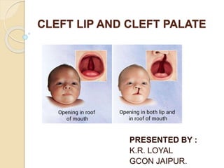 CLEFT LIP AND CLEFT PALATE
PRESENTED BY :
K.R. LOYAL
GCON JAIPUR.
 