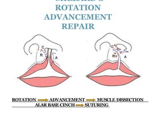 cleft lip FINAL.ppt