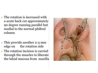 cleft lip FINAL.ppt