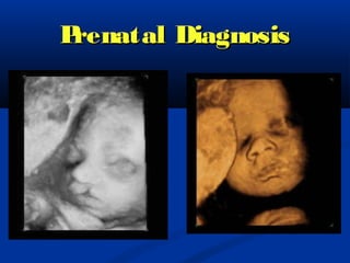 Prenatal Diagnosis
 