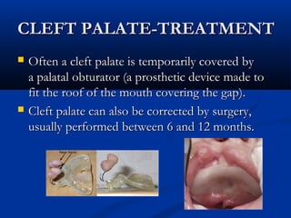 CLEFT PALATE-TREATMENT
   Often a cleft palate is temporarily covered by
    a palatal obturator (a prosthetic device made to
    fit the roof of the mouth covering the gap).
   Cleft palate can also be corrected by surgery,
    usually performed between 6 and 12 months.
 