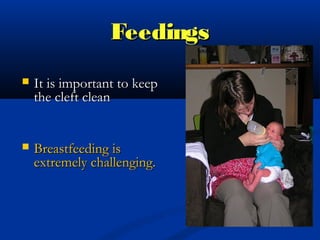 Feedings
   It is important to keep
    the cleft clean


   Breastfeeding is
    extremely challenging.
 