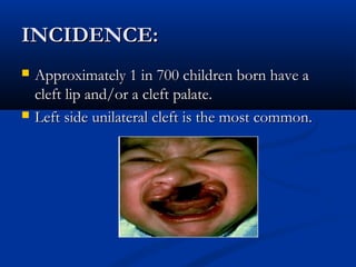 INCIDENCE:
   Approximately 1 in 700 children born have a
    cleft lip and/or a cleft palate.
   Left side unilateral cleft is the most common.
 