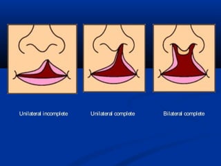 Unilateral incomplete   Unilateral complete   Bilateral complete
 