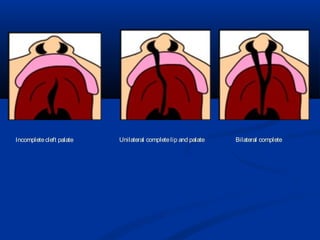 Incomplete cleft palate   Unilateral complete lip and palate   Bilateral complete
 
