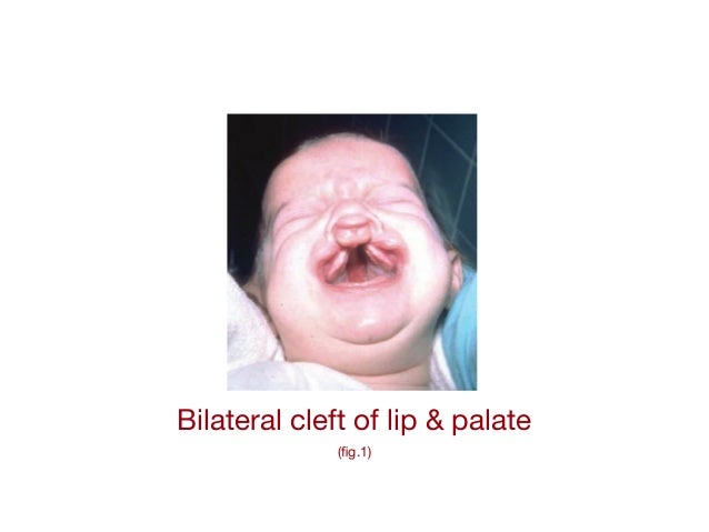 cleft lip student essay A cleft lip can range from a little notch in the coloured part of the lip to a complete separation of the upper lip which can extend up and into the nose a cleft palate is a gap in the roof of the mouth. cleft lip student essay A cleft lip can range from a little notch in the coloured part of the lip to a complete separation of the upper lip which can extend up and into the nose a cleft palate is a gap in the roof of the mouth.