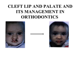 CLEFT LIP AND PALATE AND
ITS MANAGEMENT IN
ORTHODONTICS
 