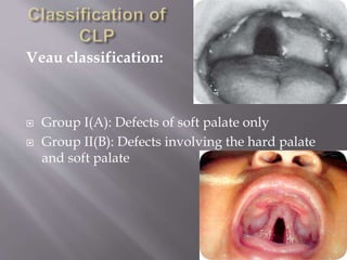Veau Classfication Cleft lip and palate | PPTX
