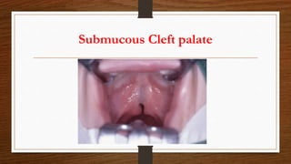 Submucous Cleft palate
 