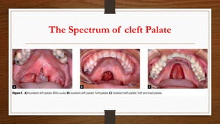 The Spectrum of cleft Palate
 