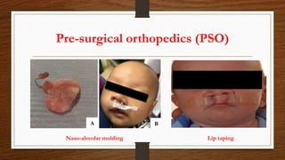 Pre-surgical orthopedics (PSO)
Naso-alveolar molding Lip taping
 
