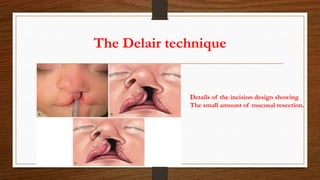 The Delair technique
Details of the incision design showing
The small amount of mucosal resection.
 