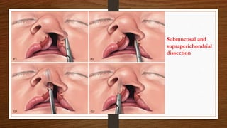 Submucosal and
supraperichondrial
dissection
 
