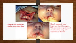 Muscle surgery is more
important than skin surgery.
This photo shows good muscle
reconstruction and passive
coaptation of the skin
Complete and watertight
Closure of the nasal floor
 