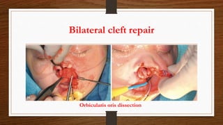 Bilateral cleft repair
Orbicularis oris dissection
 