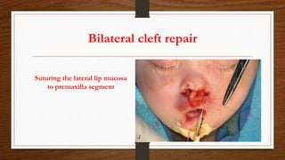 Bilateral cleft repair
Suturing the lateral lip mucosa
to premaxilla segment
 