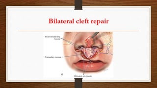 Bilateral cleft repair
 