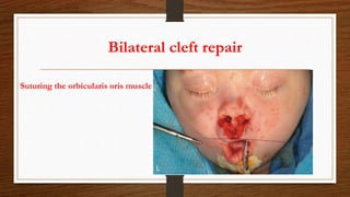 Bilateral cleft repair
Suturing the orbicularis oris muscle
 