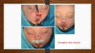 Complete skin closure
 