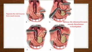 Separate the oral mucosa
from nasal mucosa
Release the abnormal levators
muscle Attachment
to hard palate
 