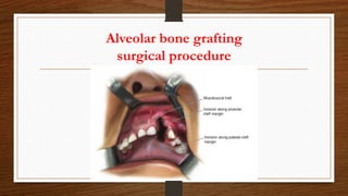 Alveolar bone grafting
surgical procedure
 