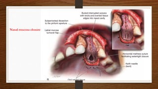 Nasal mucosa closure
 