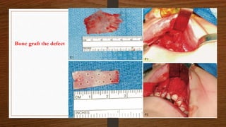 Bone graft the defect
 