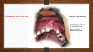 Closure of oral mucosa
 