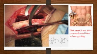 Iliac crest; is the most
commonly used bone
in bone grafting
 