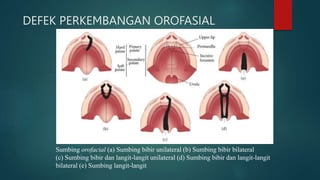 DEFEK PERKEMBANGAN OROFASIAL
Sumbing orofacial (a) Sumbing bibir unilateral (b) Sumbing bibir bilateral
(c) Sumbing bibir dan langit-langit unilateral (d) Sumbing bibir dan langit-langit
bilateral (e) Sumbing langit-langit
 