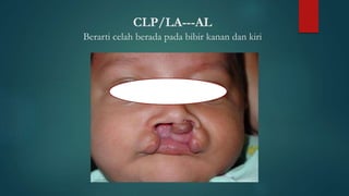 CLP/LA---AL
Berarti celah berada pada bibir kanan dan kiri
 