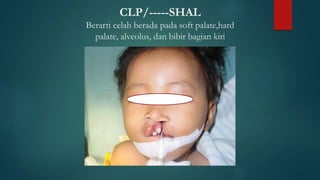 CLP/-----SHAL
Berarti celah berada pada soft palate,hard
palate, alveolus, dan bibir bagian kiri
 
