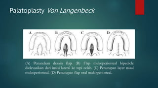 (A) Penandaan desain flap. (B) Flap mukoperiosteal bipedicle
dielevasikan dari insisi lateral ke tepi celah. (C) Penutupan layer nasal
mukoperiosteal. (D) Penutupan flap oral mukoperiosteal.
Palatoplasty Von Langenbeck
 
