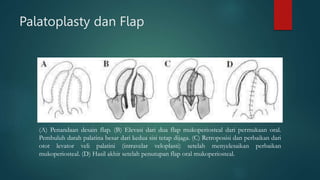 Palatoplasty dan Flap
(A) Penandaan desain flap. (B) Elevasi dari dua flap mukoperiosteal dari permukaan oral.
Pembuluh darah palatina besar dari kedua sisi tetap dijaga. (C) Retroposisi dan perbaikan dari
otot levator veli palatini (intravelar veloplasti) setelah menyelesaikan perbaikan
mukoperiosteal. (D) Hasil akhir setelah penutupan flap oral mukoperiosteal.
 