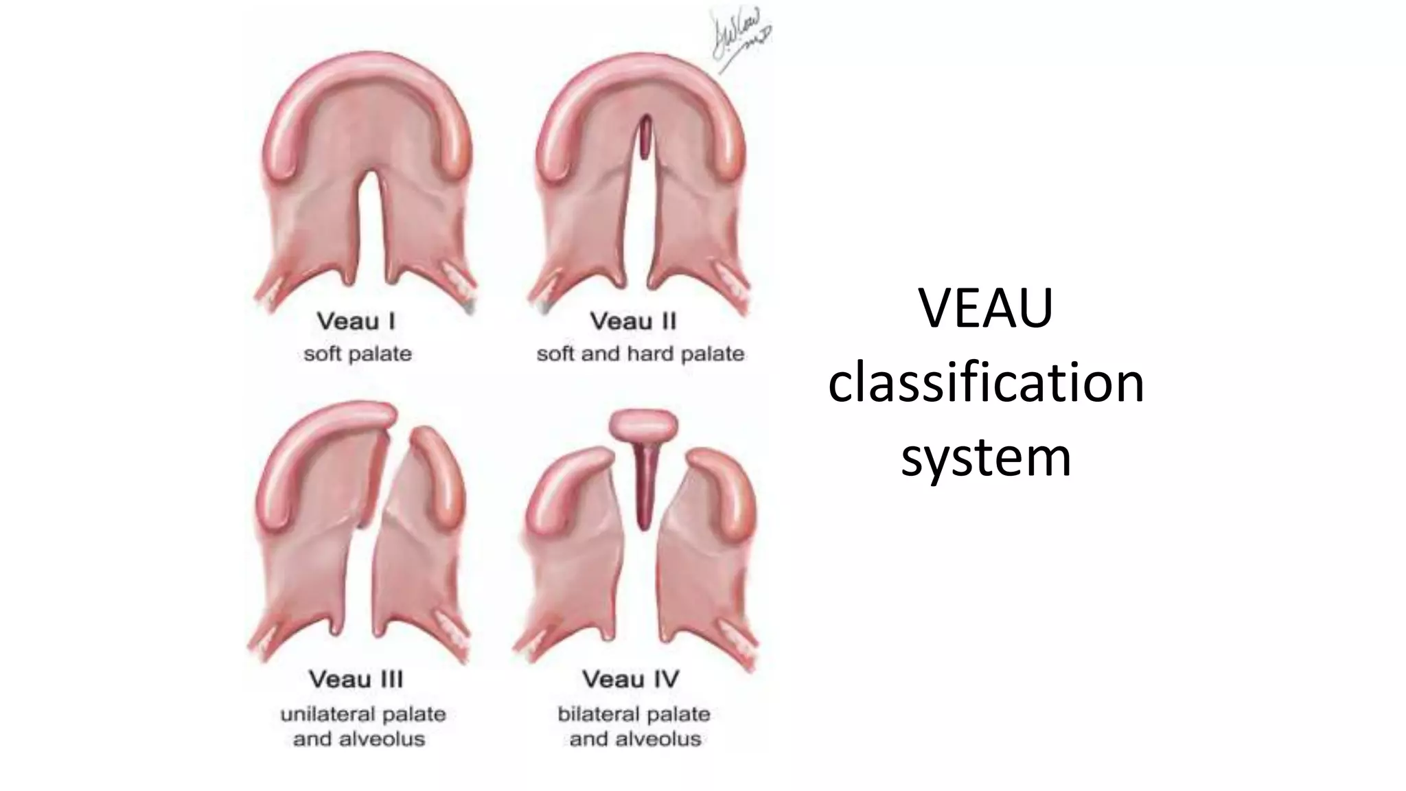Cleft lip and Cleft Palate.pptx