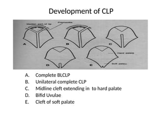 Cleft lip and Palate, etilogy and management | PPTX