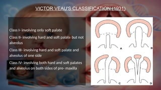Veau Classfication Comprehensive Management of Cleft Lip and Palate: Diagnosis, Treatment ...