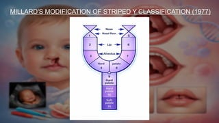 Comprehensive Management of Cleft Lip and Palate: Diagnosis, Treatment ...